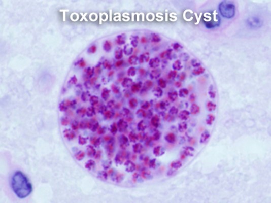 Toxoplasmosis cyst