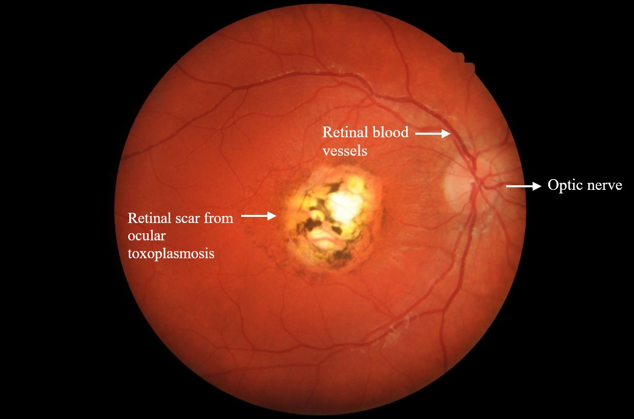 toxoplasmosis retina