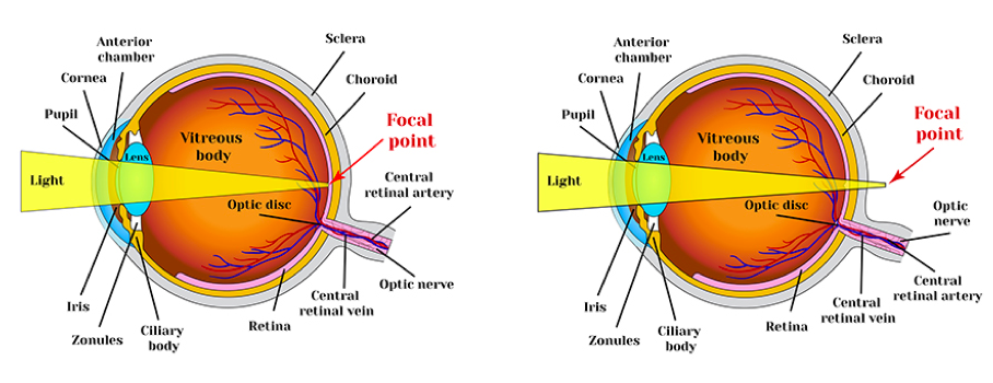 what-does-it-mean-to-be-short-sighted-myopic-finchley-s-multi