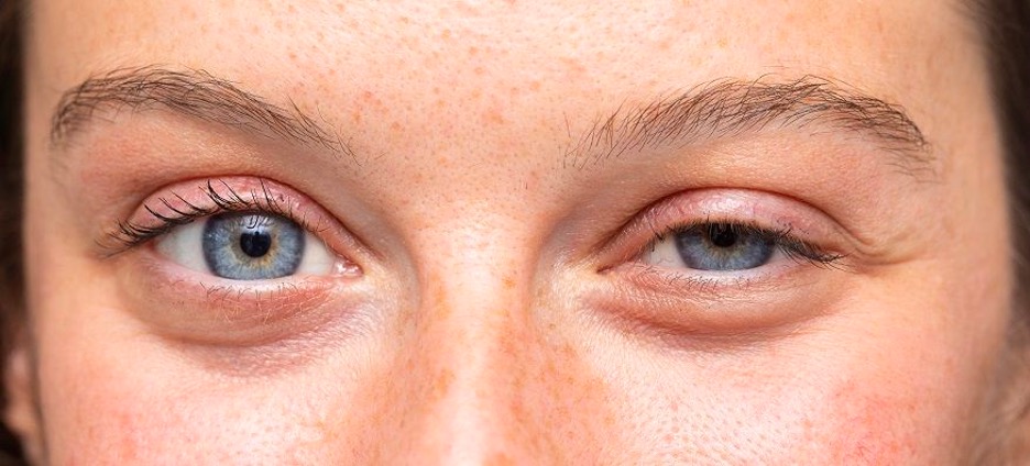 What is ptosis and how do I treat it? | Plano Eye Health