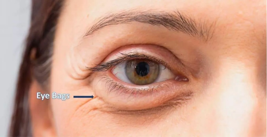 Clifford Eye Bag Protocol: Best Non-Surgical Eye Bag Removal?