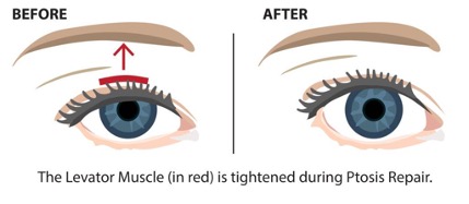 Droopy eyelid surgery