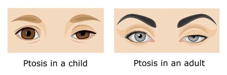 ptosis in a child and adult