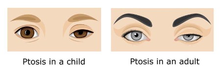 Best Eyelid Surgery (Blepharoplasty) | Plastic Surgeon in Toronto | Ford  Plastic Surgery