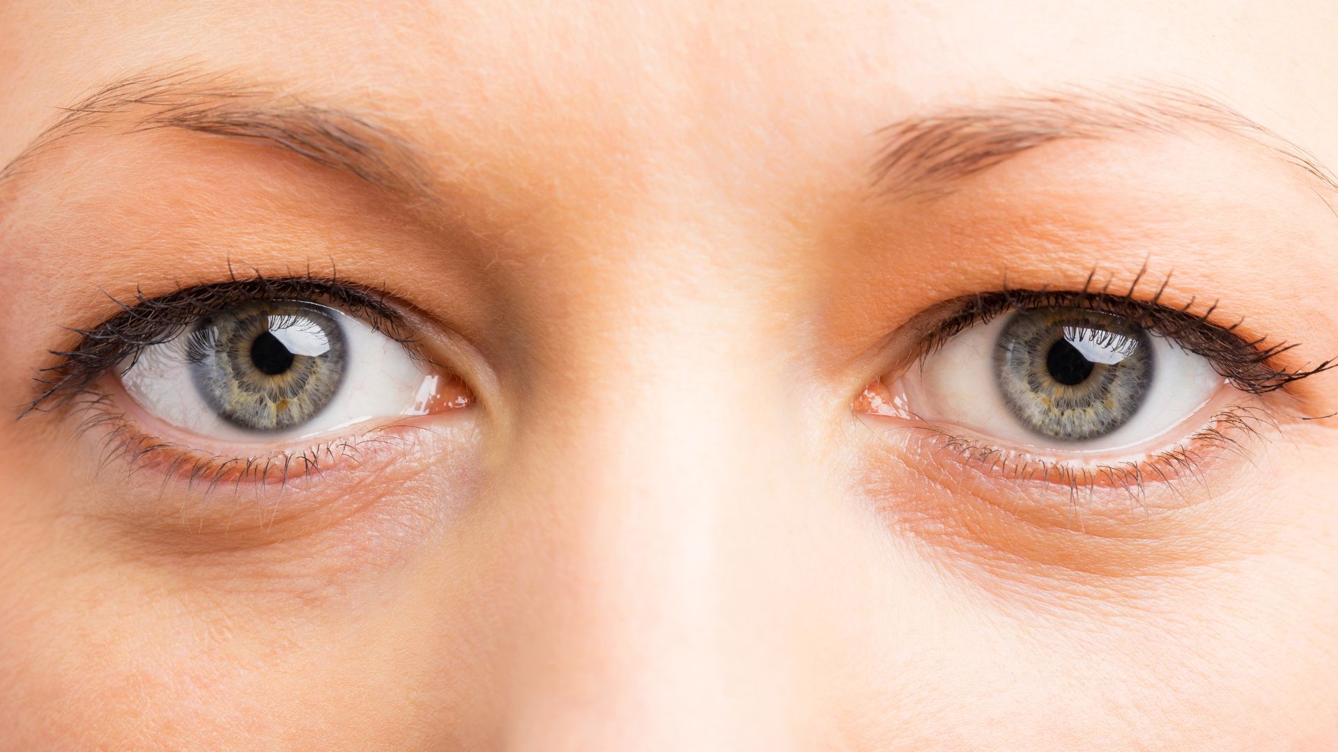 Hooded eyes - What is it, causes, and the best treatment.