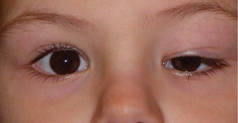 kid with ptosis on the left eye