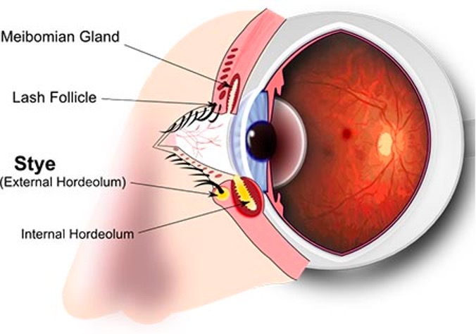 Drawing of a stye in detail and its layers
