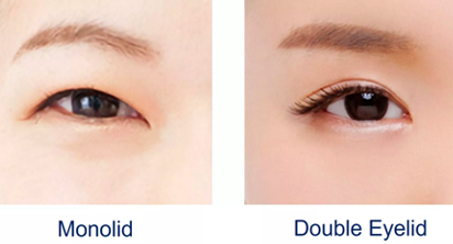 What causes on sale double eyelids