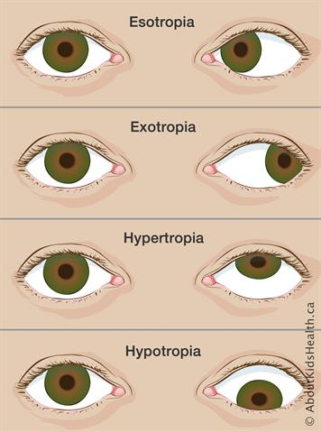 Image comparing esotropia, exotropia, hypertropia, hypotropia